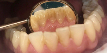 Результат проф чистки зубов ультразвуком - фото №1