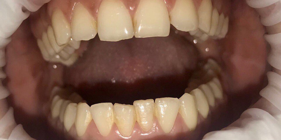 Результат проф чистки зубов ультразвуком - фото №3