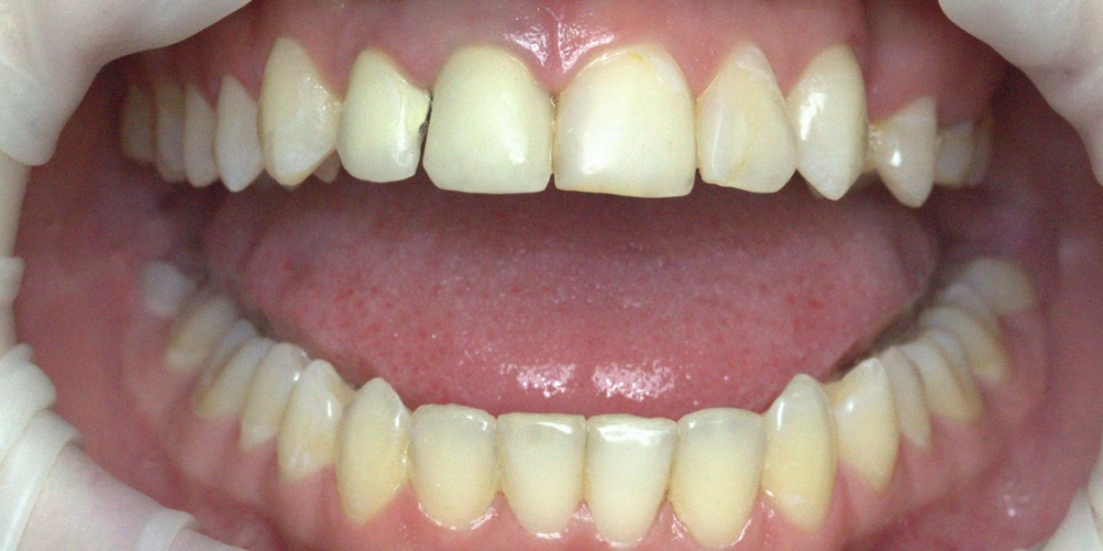 Коронки из диоксида циркония на центральные зубы - фото №1