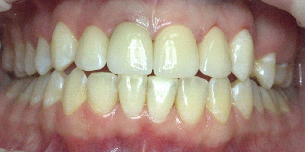 Коронки из диоксида циркония на центральные зубы - фото №2