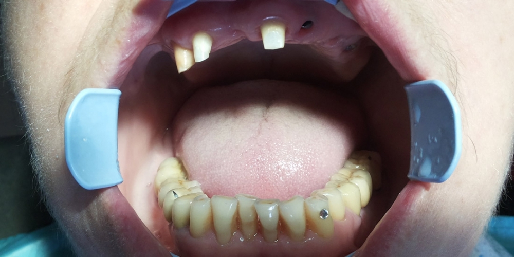 Имплантация зубов с протезированием несъемным керамическим протезом - фото №1