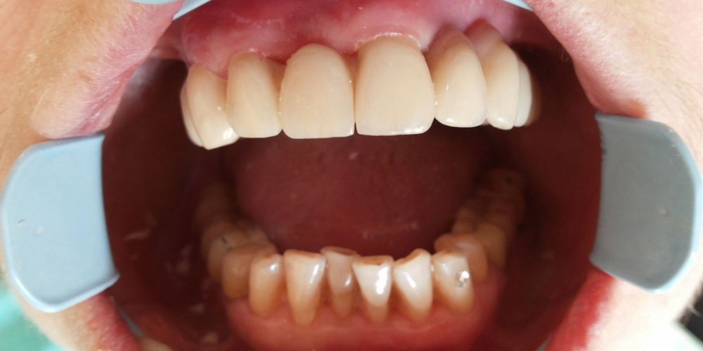 Имплантация зубов с протезированием несъемным керамическим протезом - фото №3