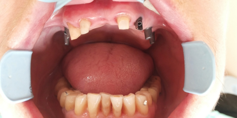 Имплантация зубов с протезированием несъемным керамическим протезом - фото №2