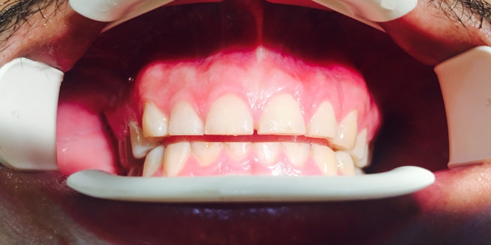 Протезирование передних зубов керамическими винирами импресс - фото №1