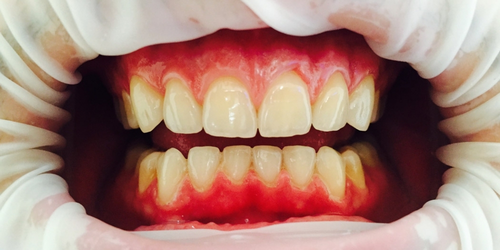 Протезирование передних зубов керамическими винирами импресс - фото №2