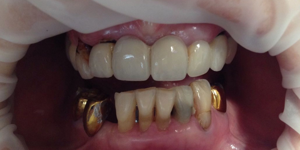 Результат протезирования зубов верхней и нижней челюсти - фото №1