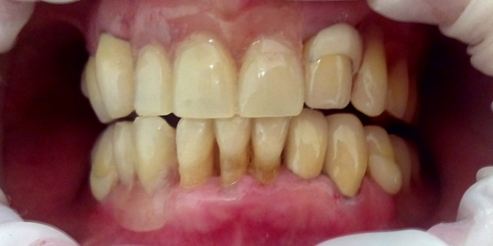 Результат протезирования зубов верхней и нижней челюсти - фото №5