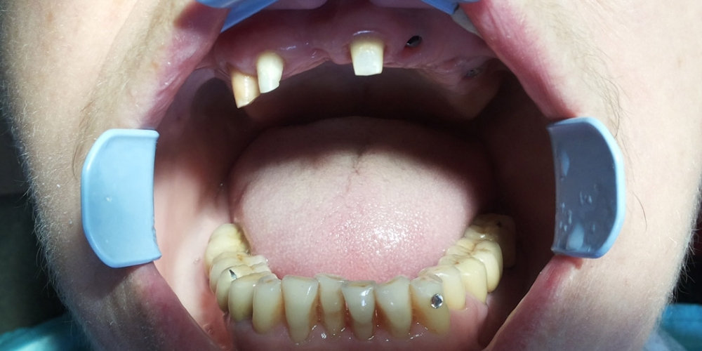 Протезирования зубов верней челюсти на имплантах - фото №1