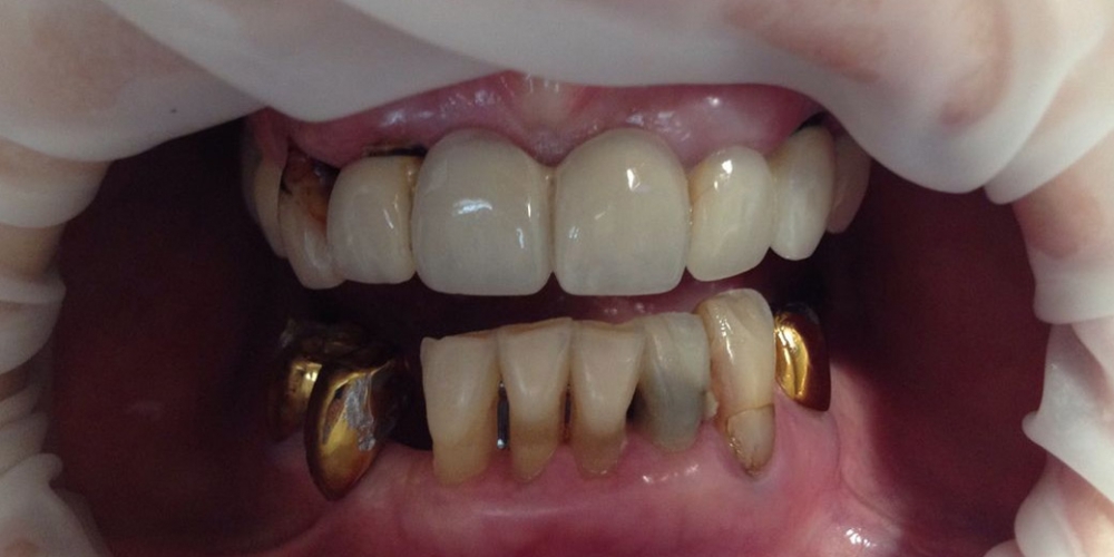 Протезирования зубов верней и нижней челюсти - фото №1