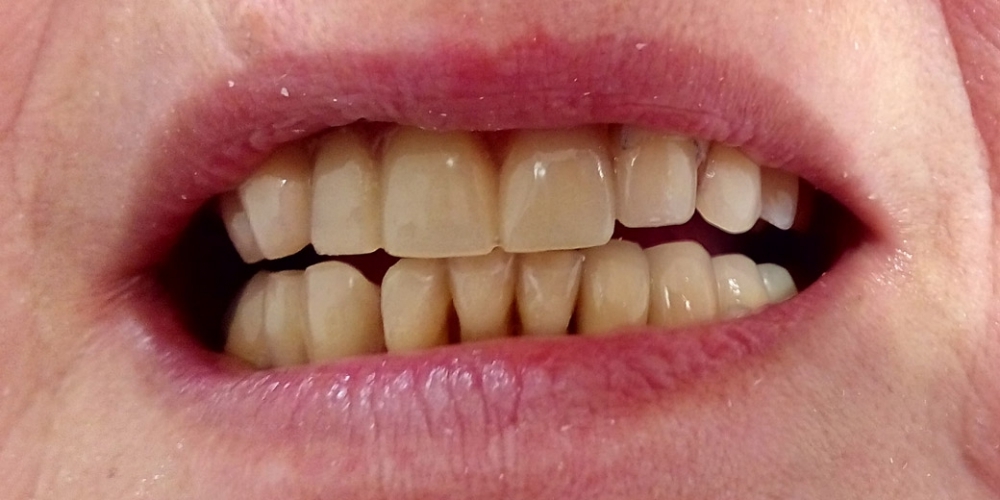 Протезирования зубов верней и нижней челюсти - фото №5