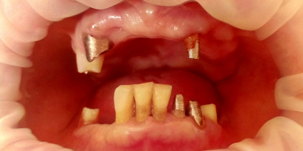 Протезирования зубов верней и нижней челюсти - фото №3