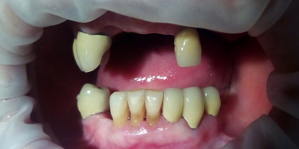 Протезирования зубов верней и нижней челюсти - фото №4