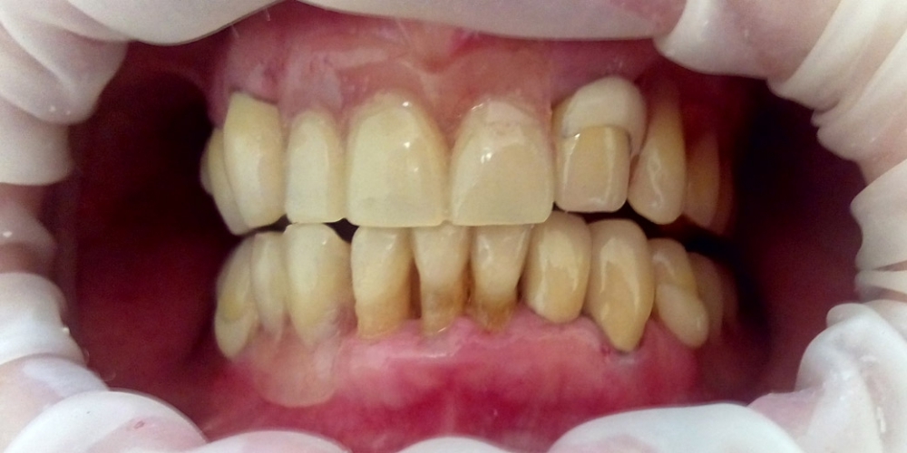 Протезирования зубов верней и нижней челюсти - фото №2