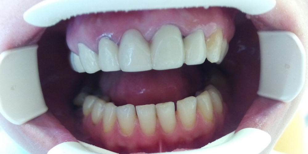 Протезирование зубов верхней челюсти металлокерамическим мостовидным протезом - фото №2