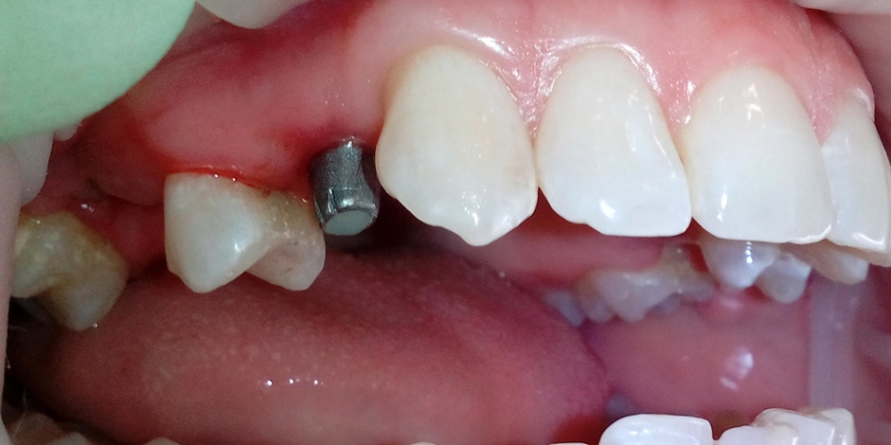 Протезирование зуба на верней челюсти справа на ранее установленном имплантанте - фото №1