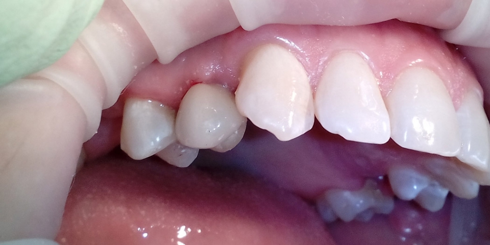 Протезирование зуба на верней челюсти справа на ранее установленном имплантанте - фото №2