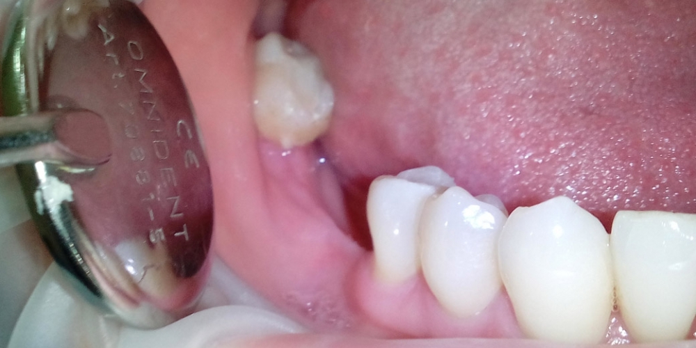 Протезирование металлокерамическим мостовидным протезом с опорой на три зуба - фото №1