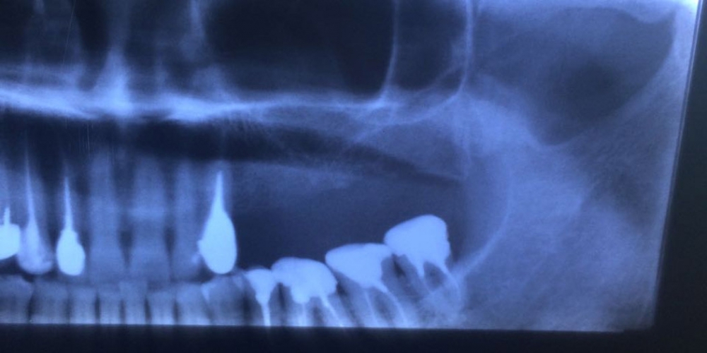 Установка трех имплантантов в области отсутствия зубов на верхней челюсти слева - фото №1