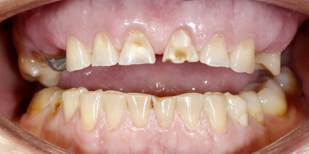 Восстановление верхних зубов керамическими коронками на основе диоксида циркония - фото №1