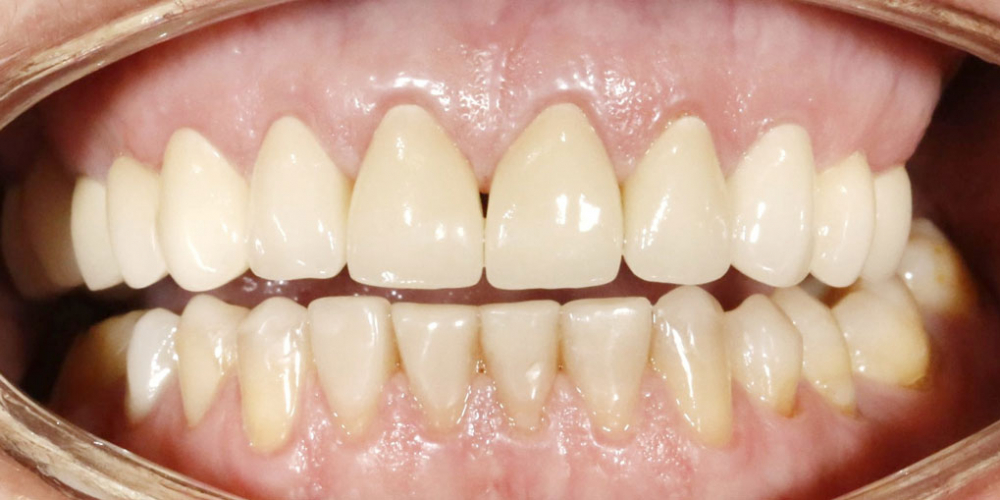 Восстановление верхних зубов керамическими коронками на основе диоксида циркония - фото №2