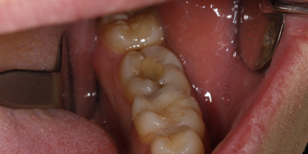 Рецидивный кариес зуба 36 - фото №1