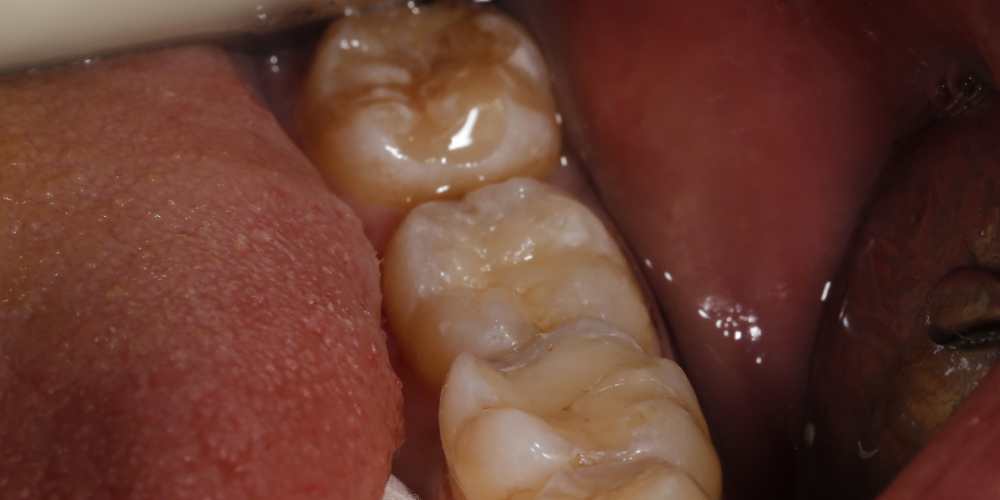 Рецидивный кариес зуба 36 - фото №2