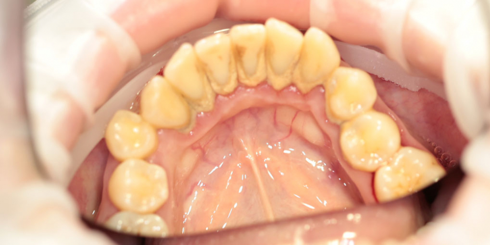 Жалобы на зубной камень, как следствие неприятный запах изо рта - фото №1