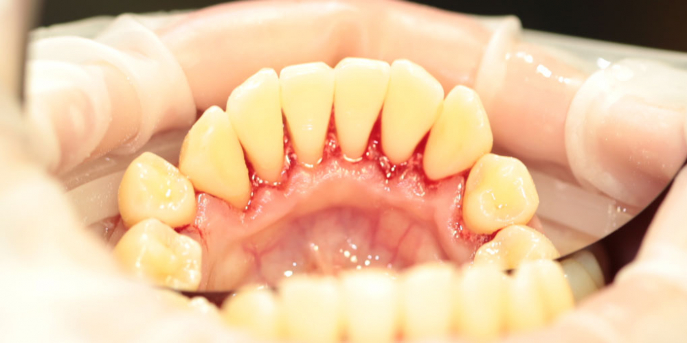 Жалобы на зубной камень, как следствие неприятный запах изо рта - фото №2