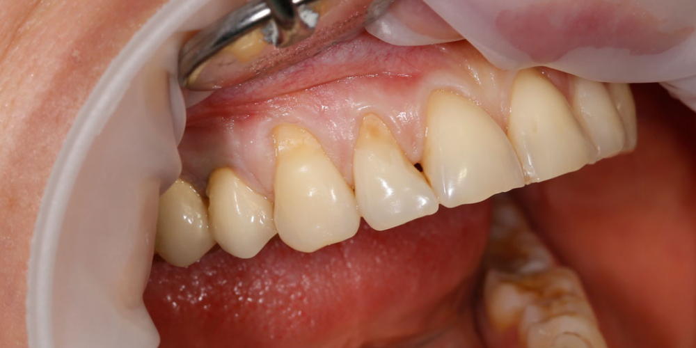 Зубы восстановили композитным реставрационным материалом Estelite - фото №1
