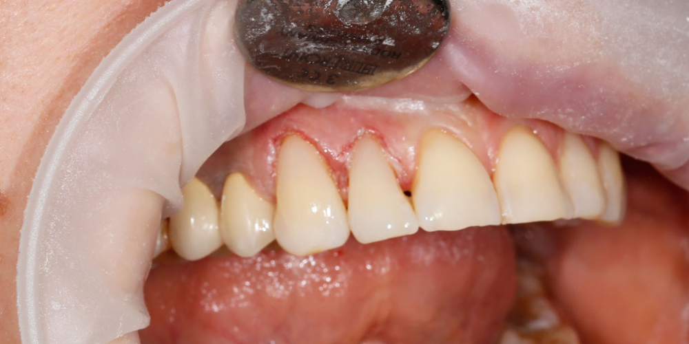 Зубы восстановили композитным реставрационным материалом Estelite - фото №2