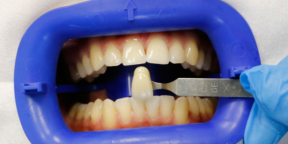 Результат отбеливание зубов системой Zoom 3 - фото №1