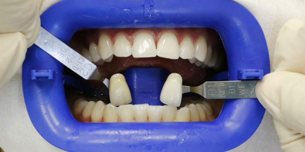 Результат отбеливание зубов системой Zoom 3 - фото №2