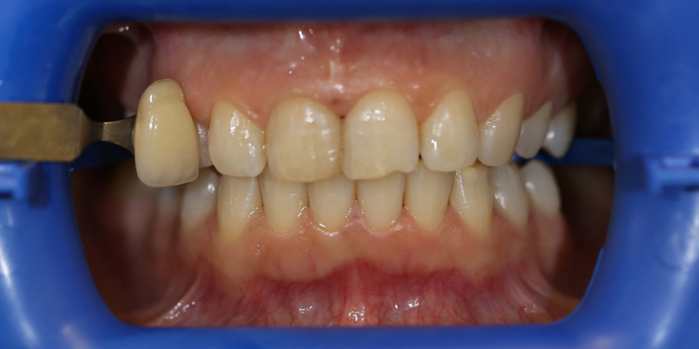 Результат отбеливания зубов системой ZOOM 3 - фото №1