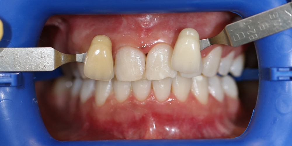 Результат отбеливания зубов системой ZOOM 3 - фото №2