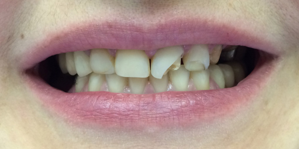 Протезирование передних зубов коронками из диоксида циркония - фото №1