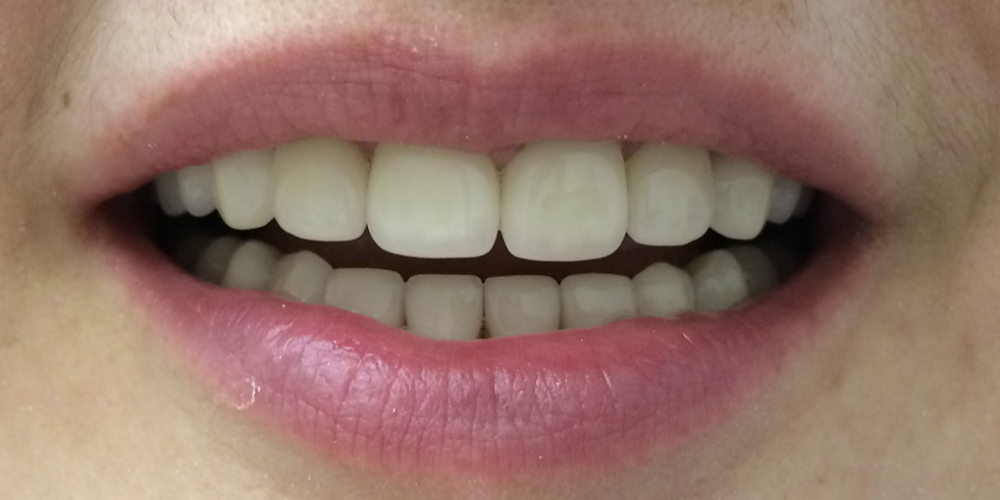 Протезирование передних зубов коронками из диоксида циркония - фото №2