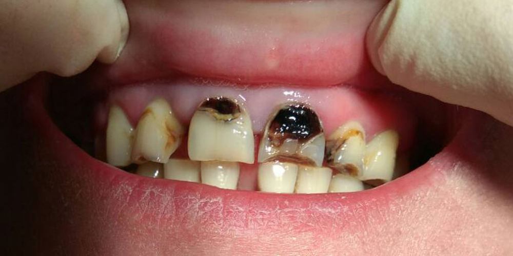 Прямая реставрация фронтальной группы зубов с помощью компазитного материала Estelite - фото №1