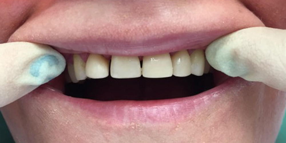 Прямая реставрация фронтальной группы зубов с помощью компазитного материала Estelite - фото №2