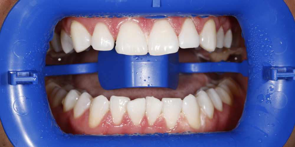 Проведена процедура отбеливания зубов Zoom 3 - фото №2