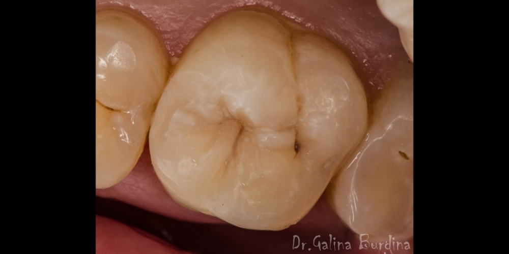 Эстетическая реставрация жевательного зуба 2.6 - фото №2