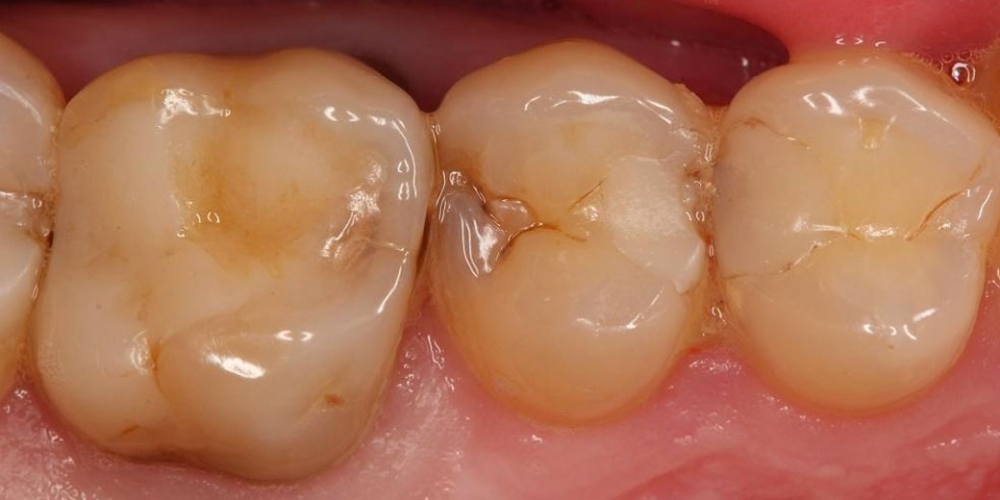 Реставрация зуба 25, лечение от чувствительных и термических раздражений, застревание пищи - фото №1