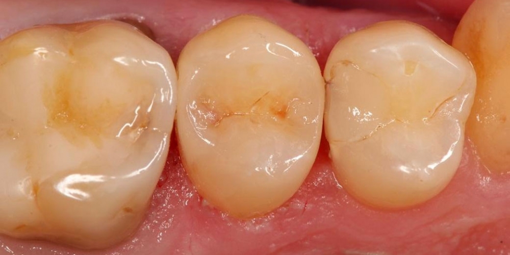 Реставрация зуба 25, лечение от чувствительных и термических раздражений, застревание пищи - фото №2