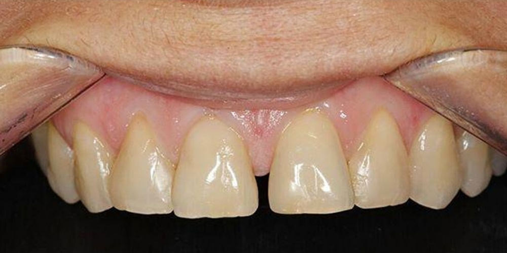Закрытие диастемы (убрать промежуток между зубами) - фото №1