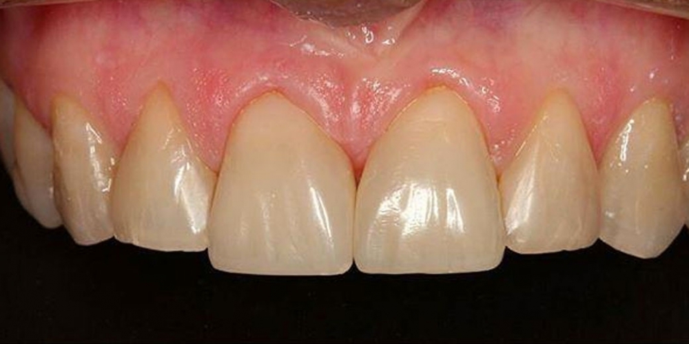 Закрытие диастемы (убрать промежуток между зубами) - фото №2