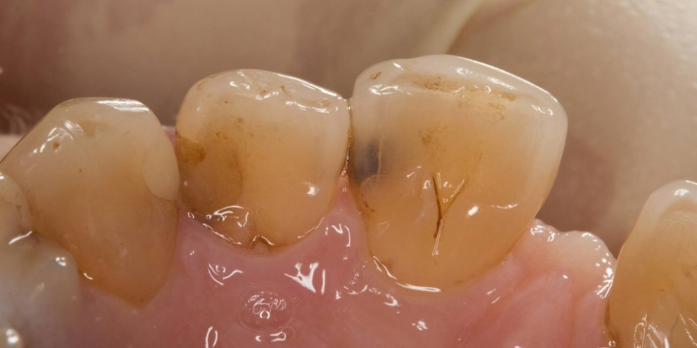 Реставрация зуба 21, дефект по 3 классу - фото №1