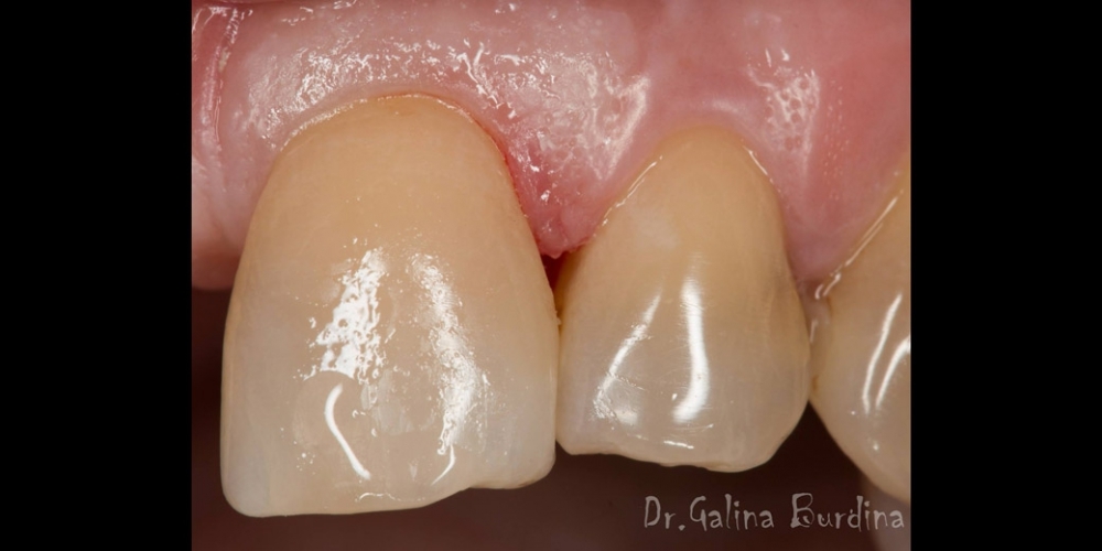 Реставрация зуба 21, дефект по 3 классу - фото №3