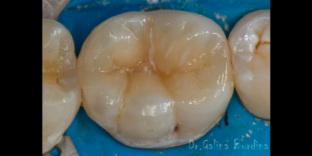Лечение вторичного кариеса под пломбой, реставрация зуба 46, МОД - фото №22