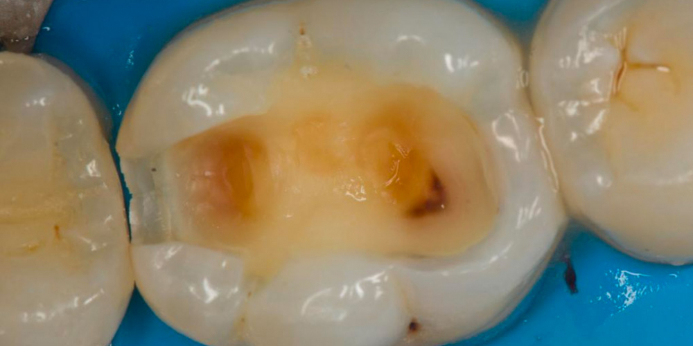 Лечение вторичного кариеса под пломбой, реставрация зуба 46, МОД - фото №3