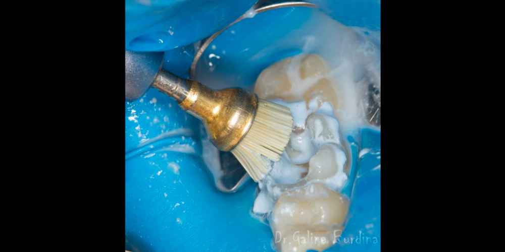 Лечение вторичного кариеса под пломбой, реставрация зуба 46, МОД - фото №4