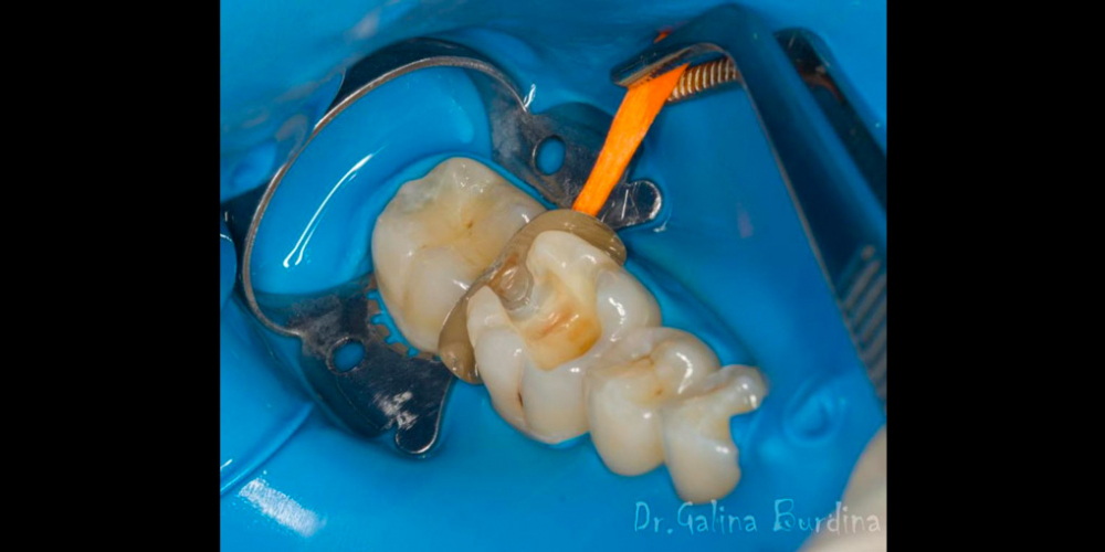 Лечение вторичного кариеса под пломбой, реставрация зуба 46, МОД - фото №5